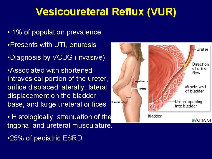 Vesicoureteral Reflux (VUR) • 1% of population prevalence • Presents with UTI, enuresis • Vesicoureteral Reflux (VUR) • 1% of population prevalence • Presents with UTI, enuresis •