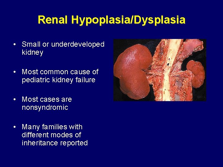 Renal Hypoplasia/Dysplasia • Small or underdeveloped kidney • Most common cause of pediatric kidney Renal Hypoplasia/Dysplasia • Small or underdeveloped kidney • Most common cause of pediatric kidney