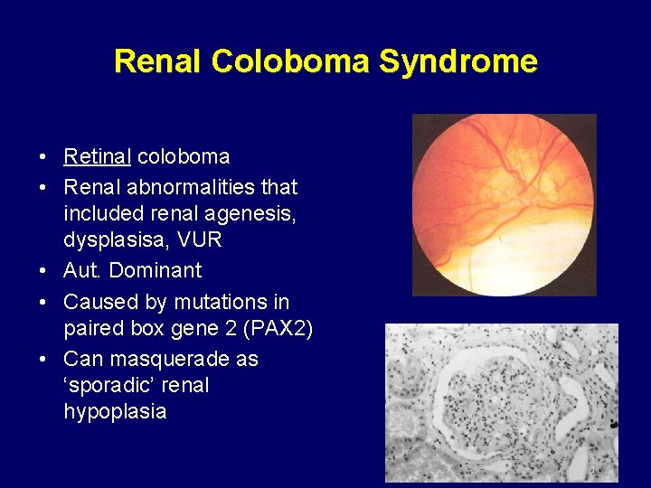 Renal Coloboma Syndrome • Retinal coloboma • Renal abnormalities that included renal agenesis, dysplasisa, Renal Coloboma Syndrome • Retinal coloboma • Renal abnormalities that included renal agenesis, dysplasisa,