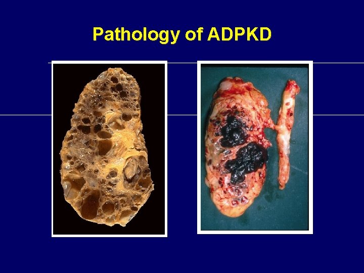 Pathology of ADPKD Pathology of ADPKD
