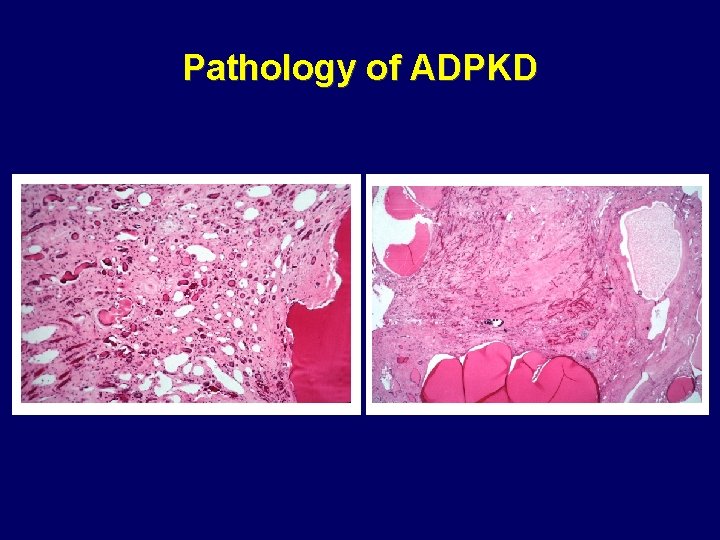 Pathology of ADPKD Pathology of ADPKD