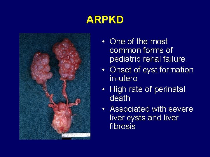 ARPKD • One of the most common forms of pediatric renal failure • Onset ARPKD • One of the most common forms of pediatric renal failure • Onset