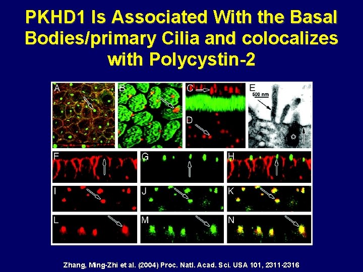 PKHD 1 Is Associated With the Basal Bodies/primary Cilia and colocalizes with Polycystin-2 Zhang, PKHD 1 Is Associated With the Basal Bodies/primary Cilia and colocalizes with Polycystin-2 Zhang,