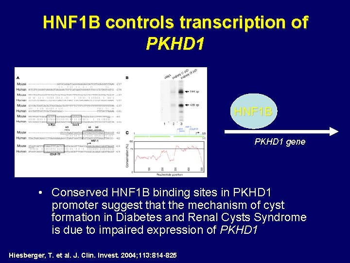 HNF 1 B controls transcription of PKHD 1 • HNF 1 B PKHD 1 HNF 1 B controls transcription of PKHD 1 • HNF 1 B PKHD 1