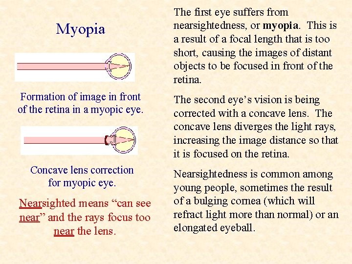 Myopia The first eye suffers from nearsightedness, or myopia. This is a result of