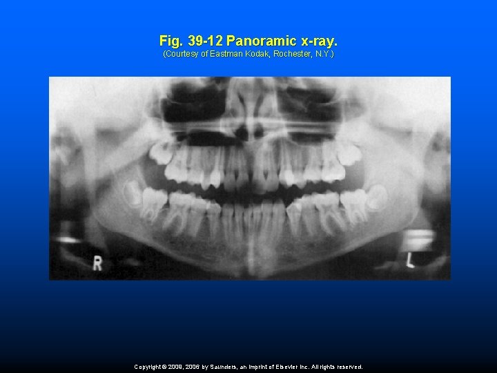 Fig. 39 -12 Panoramic x-ray. (Courtesy of Eastman Kodak, Rochester, N. Y. ) Copyright