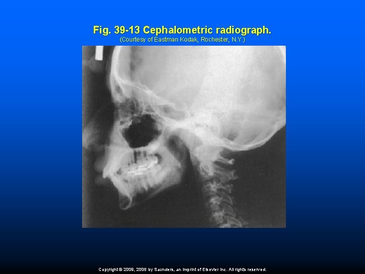 Fig. 39 -13 Cephalometric radiograph. (Courtesy of Eastman Kodak, Rochester, N. Y. ) Copyright