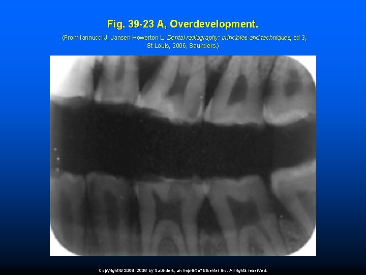 Fig. 39 -23 A, Overdevelopment. (From Iannucci J, Jansen Howerton L: Dental radiography: principles