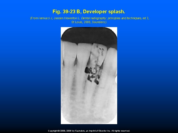 Fig. 39 -23 B, Developer splash. (From Iannucci J, Jansen Howerton L: Dental radiography: