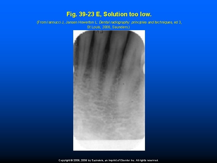Fig. 39 -23 E, Solution too low. (From Iannucci J, Jansen Howerton L: Dental