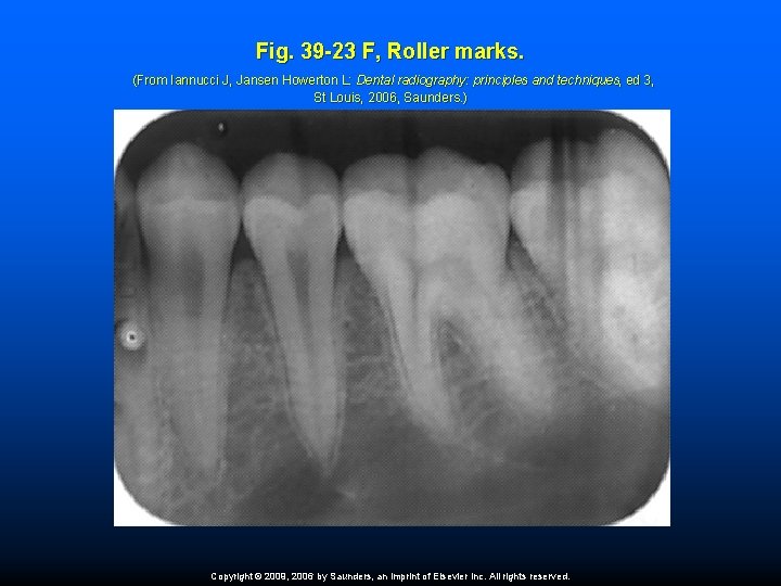 Fig. 39 -23 F, Roller marks. (From Iannucci J, Jansen Howerton L: Dental radiography: