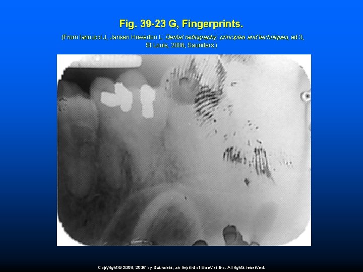 Fig. 39 -23 G, Fingerprints. (From Iannucci J, Jansen Howerton L: Dental radiography: principles