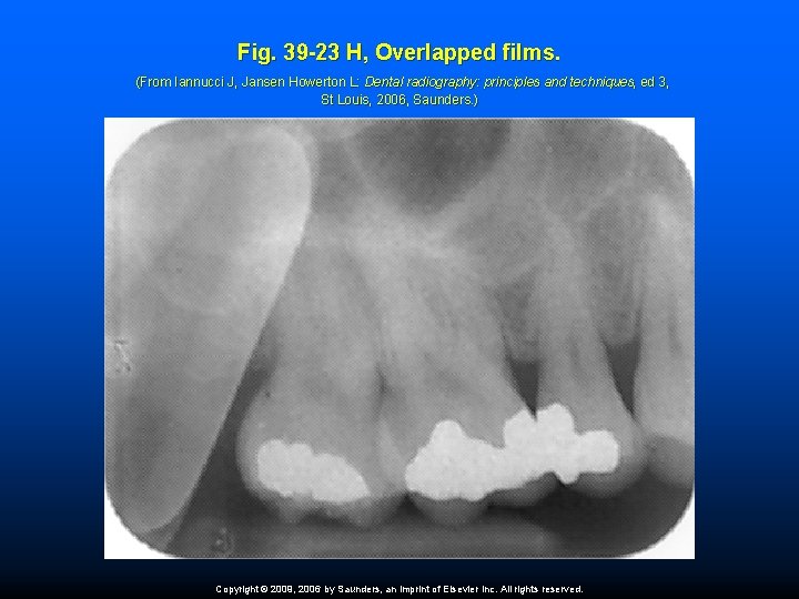 Fig. 39 -23 H, Overlapped films. (From Iannucci J, Jansen Howerton L: Dental radiography: