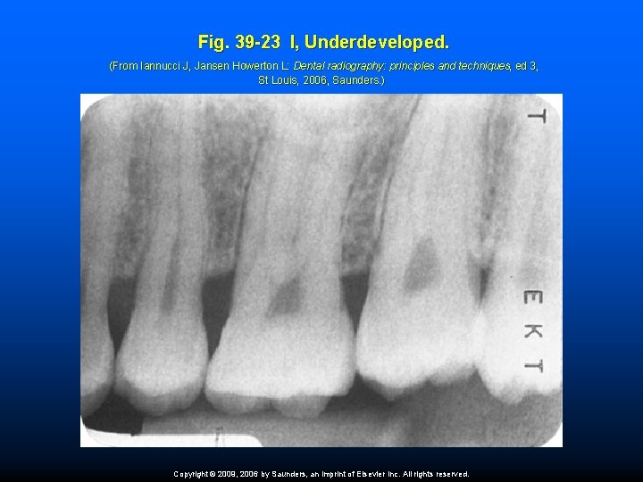 Fig. 39 -23 I, Underdeveloped. (From Iannucci J, Jansen Howerton L: Dental radiography: principles