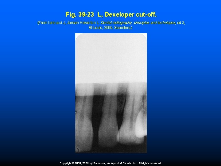 Fig. 39 -23 L, Developer cut-off. (From Iannucci J, Jansen Howerton L: Dental radiography: