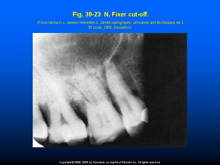 Fig. 39 -23 N, Fixer cut-off. (From Iannucci J, Jansen Howerton L: Dental radiography:
