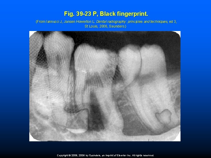 Fig. 39 -23 P, Black fingerprint. (From Iannucci J, Jansen Howerton L: Dental radiography: