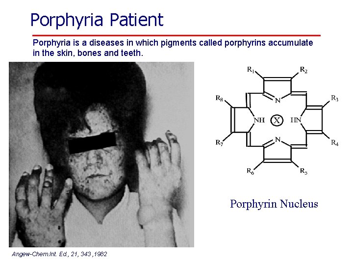 Porphyria Patient Porphyria is a diseases in which pigments called porphyrins accumulate in the