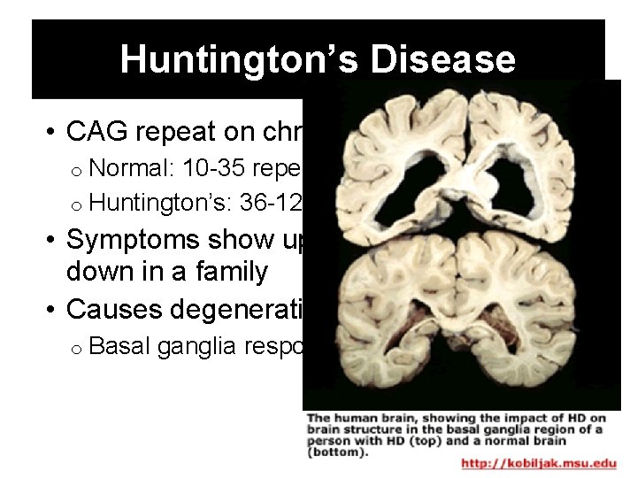 Huntington’s Disease • CAG repeat on chromosome 4 o Normal: 10 -35 repeats o