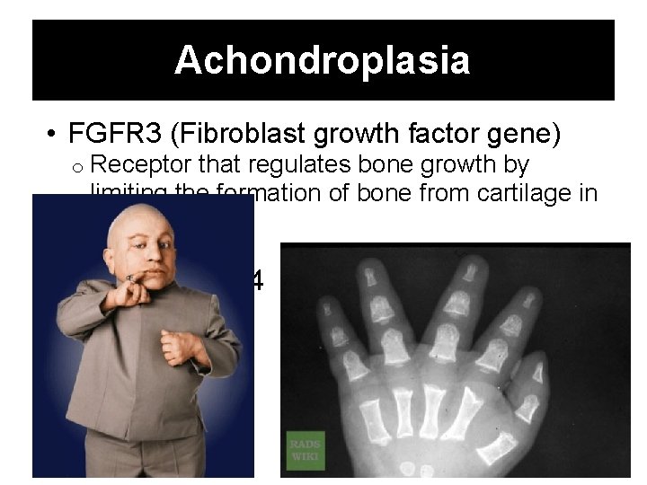 Achondroplasia • FGFR 3 (Fibroblast growth factor gene) o Receptor that regulates bone growth