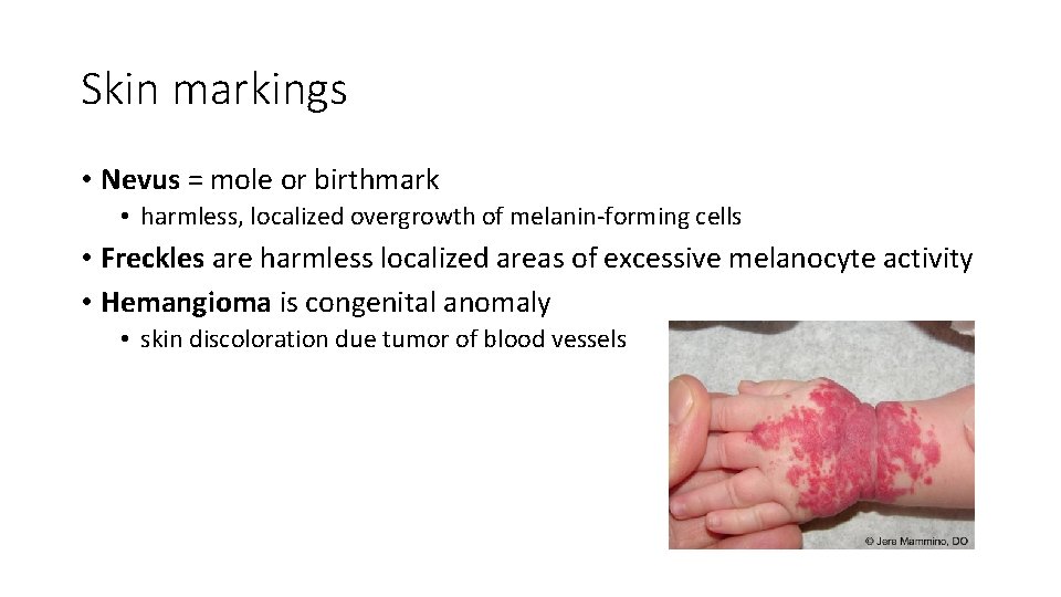 Skin markings • Nevus = mole or birthmark • harmless, localized overgrowth of melanin-forming