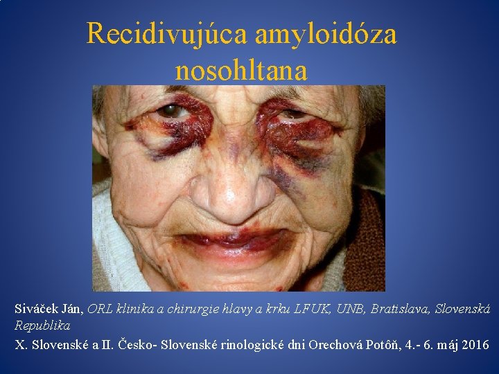 Recidivujúca amyloidóza nosohltana Siváček Ján, ORL klinika a chirurgie hlavy a krku LFUK, UNB,
