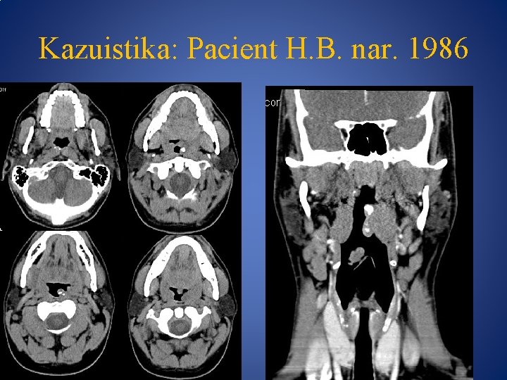 Kazuistika: Pacient H. B. nar. 1986 