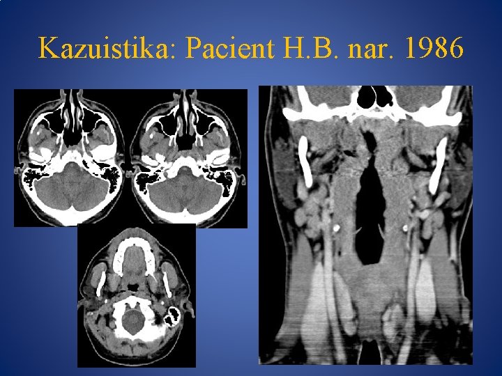 Kazuistika: Pacient H. B. nar. 1986 