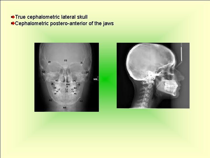 True cephalometric lateral skull Cephalometric postero-anterior of the jaws 