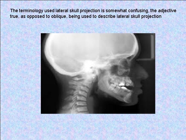 The terminology used lateral skull projection is somewhat confusing, the adjective true, as opposed