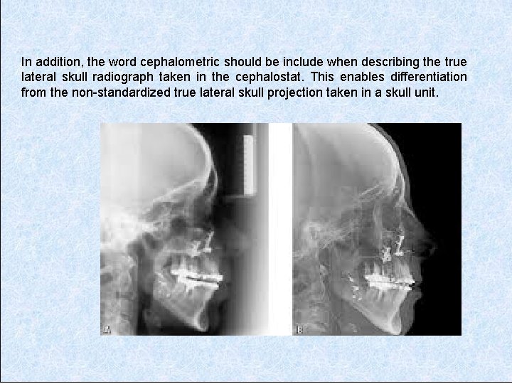 In addition, the word cephalometric should be include when describing the true lateral skull