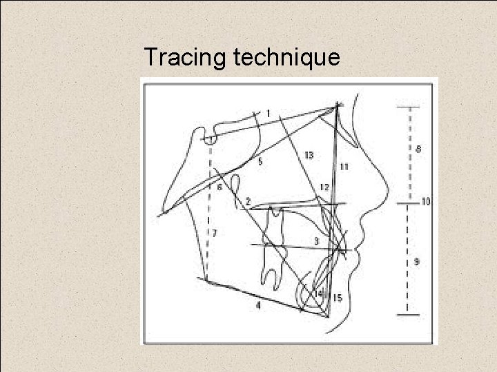 Tracing technique 