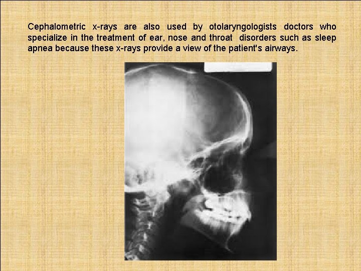 Cephalometric x-rays are also used by otolaryngologists doctors who specialize in the treatment of