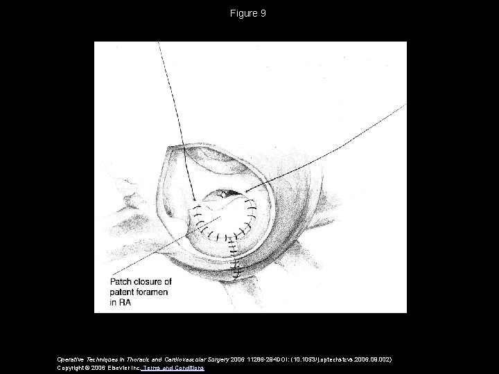 Figure 9 Operative Techniques in Thoracic and Cardiovascular Surgery 2006 11286 -294 DOI: (10.