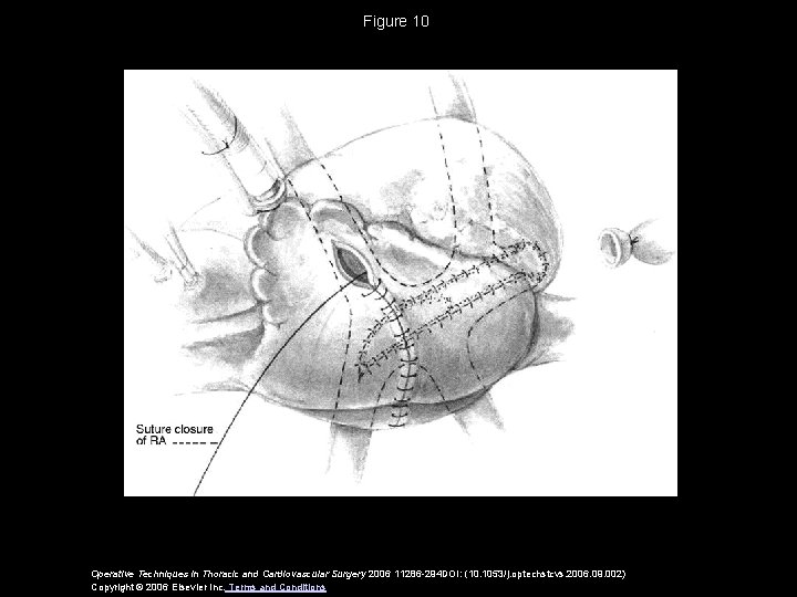 Figure 10 Operative Techniques in Thoracic and Cardiovascular Surgery 2006 11286 -294 DOI: (10.