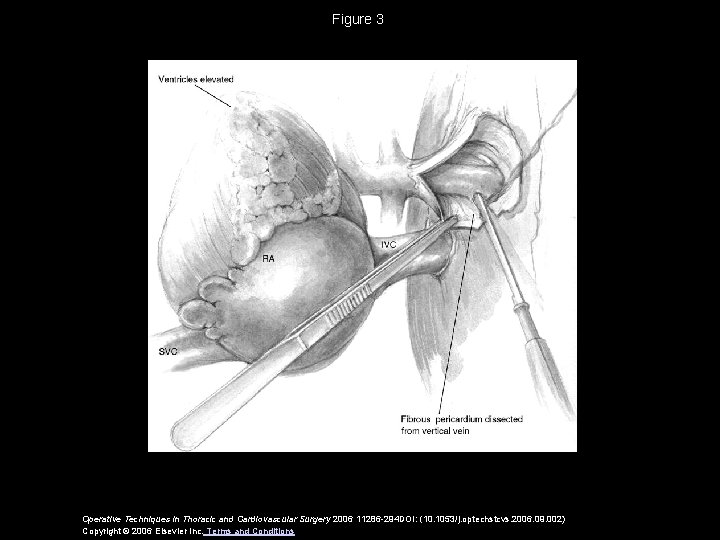 Figure 3 Operative Techniques in Thoracic and Cardiovascular Surgery 2006 11286 -294 DOI: (10.