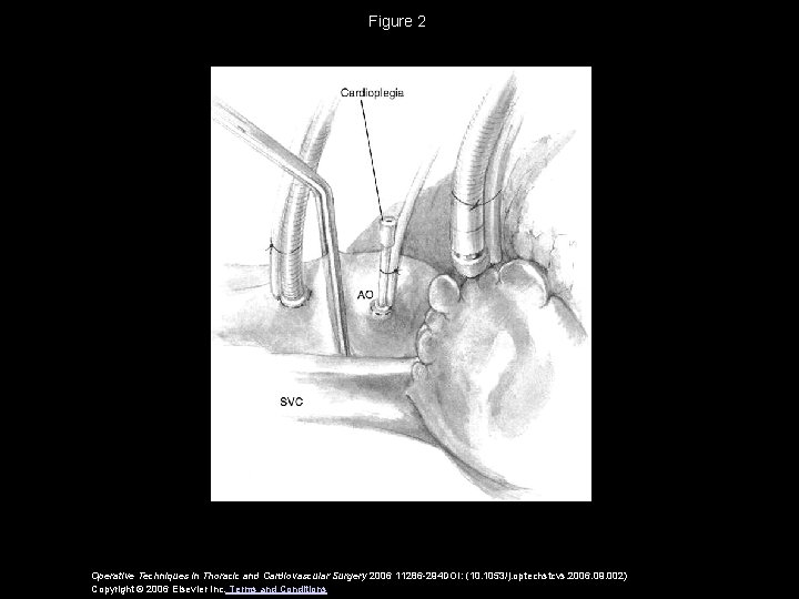 Figure 2 Operative Techniques in Thoracic and Cardiovascular Surgery 2006 11286 -294 DOI: (10.