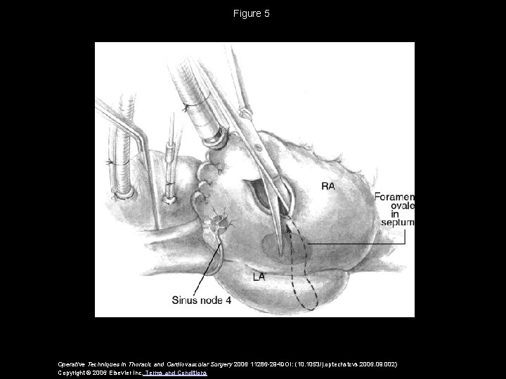 Figure 5 Operative Techniques in Thoracic and Cardiovascular Surgery 2006 11286 -294 DOI: (10.