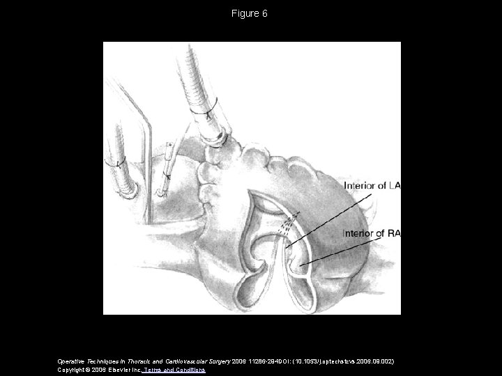 Figure 6 Operative Techniques in Thoracic and Cardiovascular Surgery 2006 11286 -294 DOI: (10.