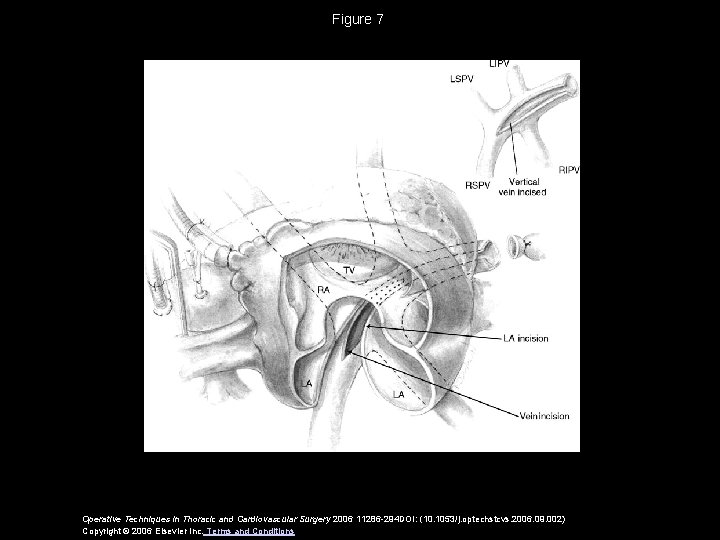 Figure 7 Operative Techniques in Thoracic and Cardiovascular Surgery 2006 11286 -294 DOI: (10.