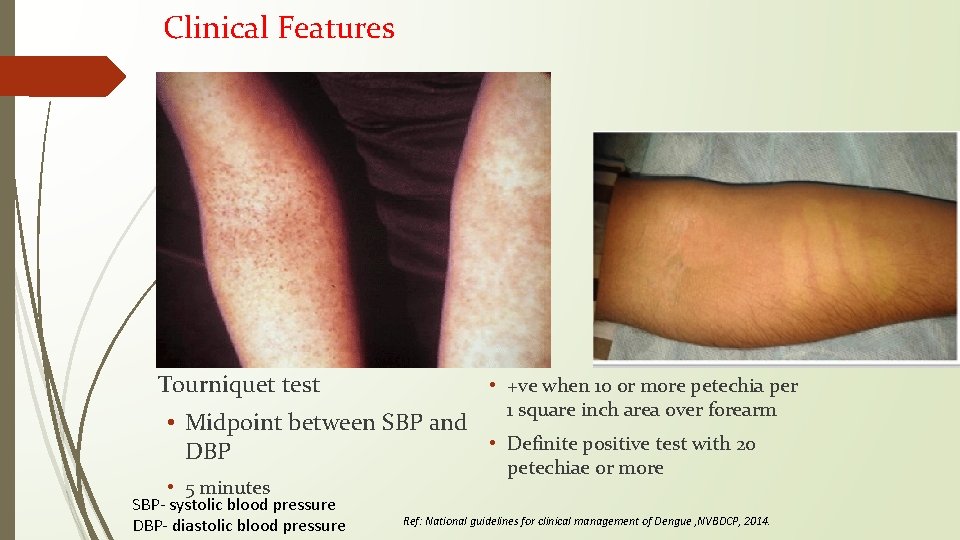 Clinical Features Tourniquet test • +ve when 10 or more petechia per 1 square