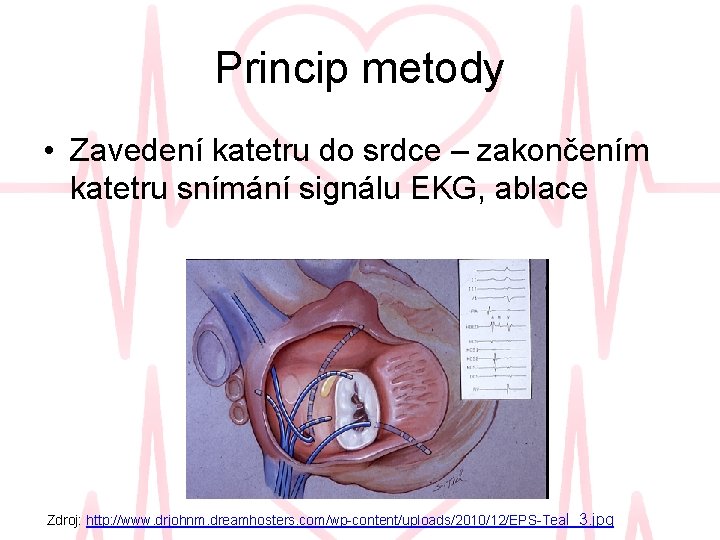 Princip metody • Zavedení katetru do srdce – zakončením katetru snímání signálu EKG, ablace