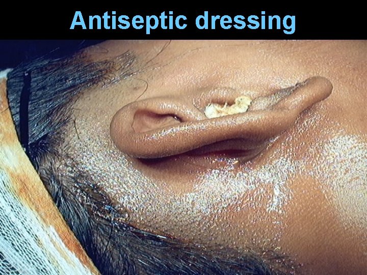 Antiseptic dressing Antiseptic dressing