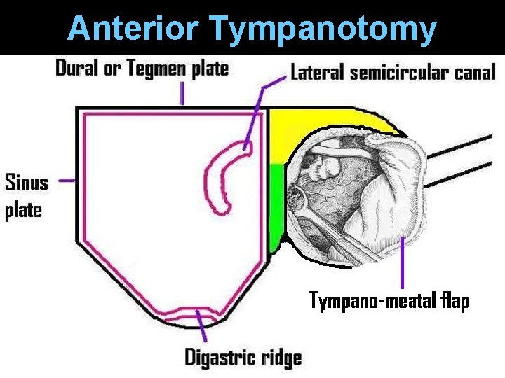 Anterior Tympanotomy Anterior Tympanotomy