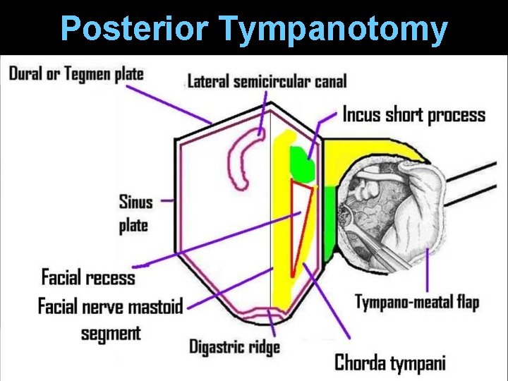Posterior Tympanotomy Posterior Tympanotomy
