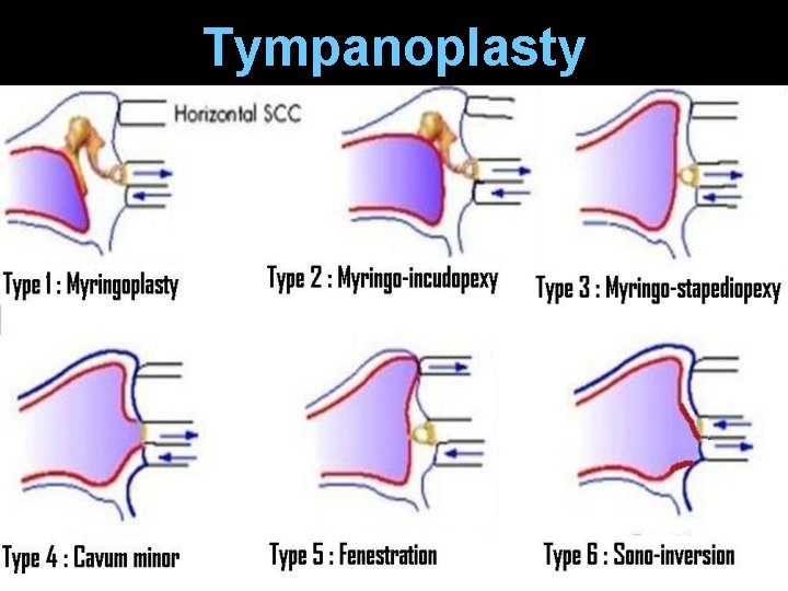Tympanoplasty Tympanoplasty