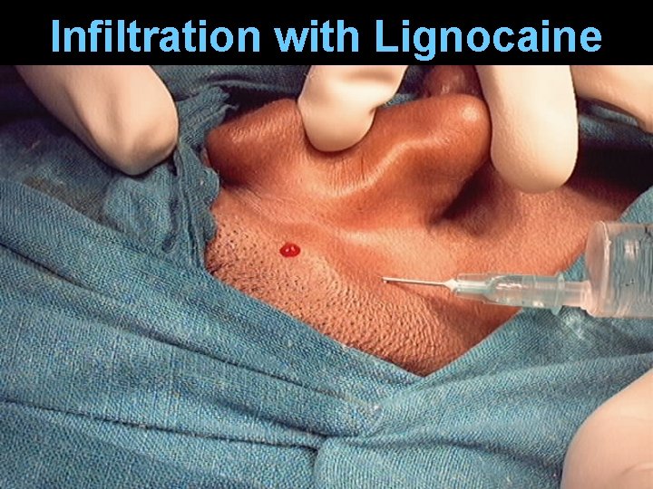 Infiltration with Lignocaine Infiltration with Lignocaine