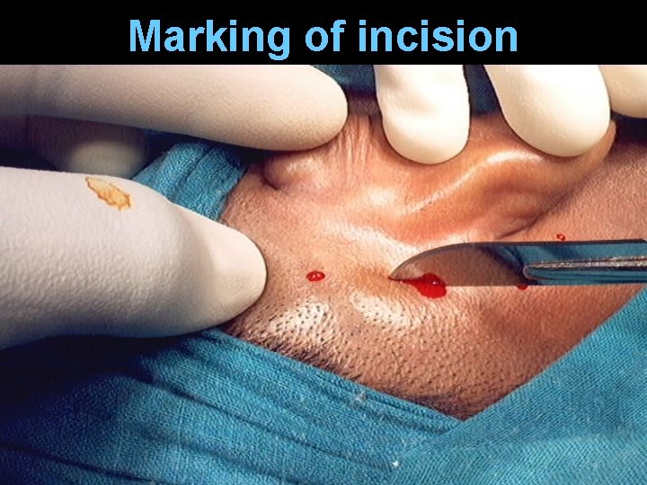 Marking of incision Marking of incision