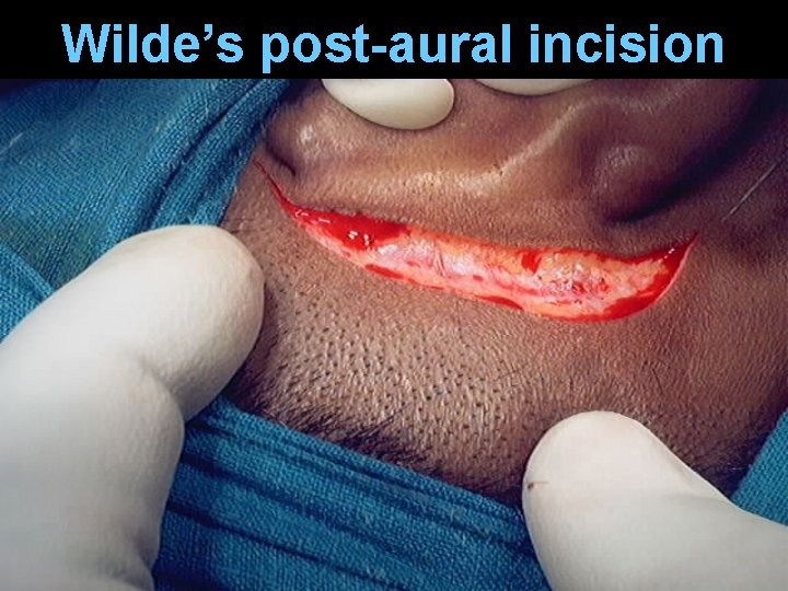 Wilde’s post-aural incision Wilde’s post-aural incision