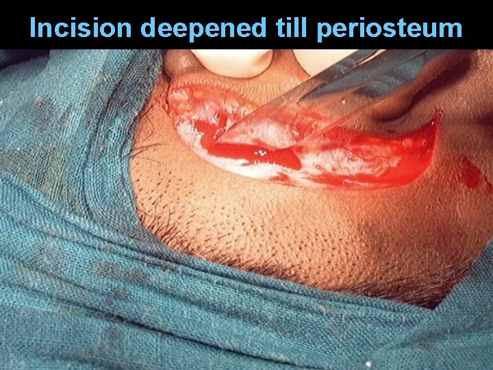Incision deepened till periosteum Incision deepened till periosteum